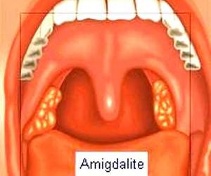Amigdalite