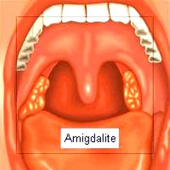 Amigdalite