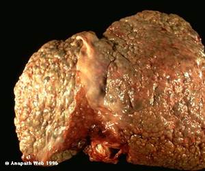 Hepatite C