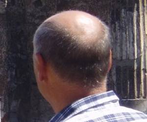 Finasterida