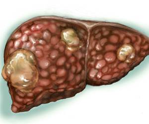 Hepatite B
