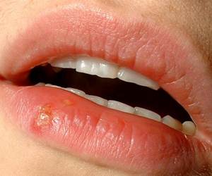 Herpes Labial, um incômodo para milhares de pessoas
