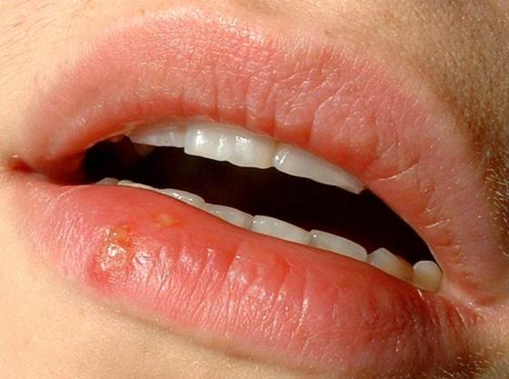 Detalhe Herpes Labial