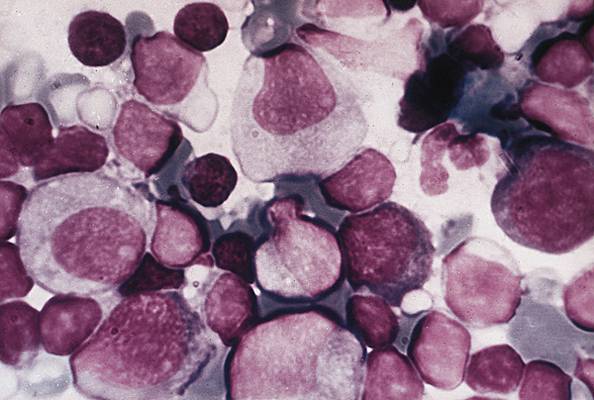 Mononucleose